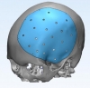 3D- implant for unique surgery was modelled in Stavropol State Agrarian University for the first time in the South of Russia